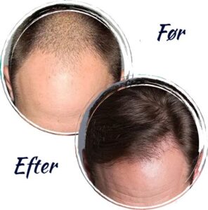 Före- och efterbilder på en hårtransplantation för blogginlägg om Nordic Hair Clinic.