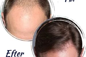 Före- och efterbilder på en hårtransplantation för blogginlägg om Nordic Hair Clinic.